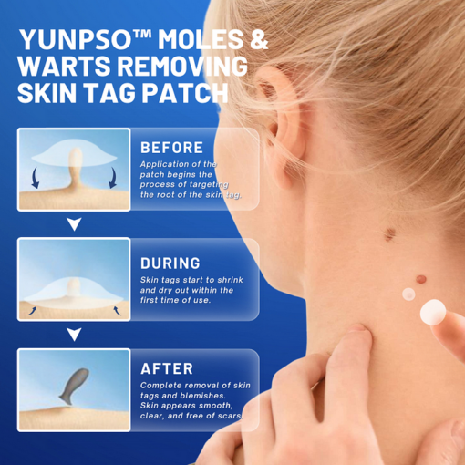YUNPSO™ Moles & Warts Removing Skin Tag Patch - Image 3