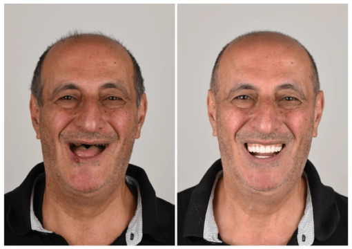 YUNPSO™ 3D Dentures - Image 2
