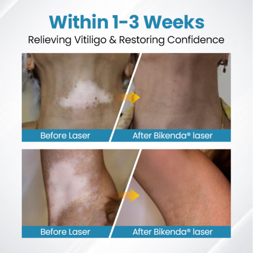 YUNPSO™ MelanoZap Vitiligo Therapy Device - Image 4