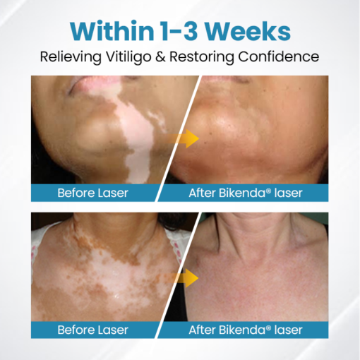 YUNPSO™ MelanoZap Vitiligo Therapy Device - Image 2