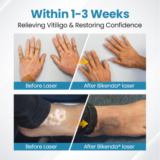 YUNPSO™ MelanoZap Vitiligo Therapy Device - Image 3