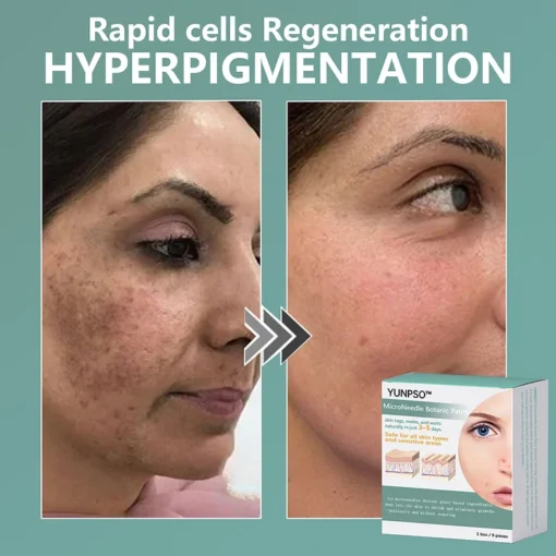 YUNPSO™ MicroNeedle Botanic Skin Tag Removal Patch - Image 3