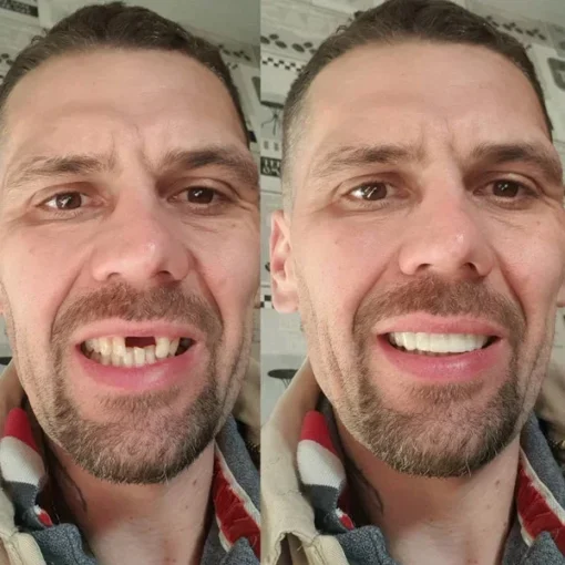 YUNPSO™ -Advanced Custom-Fit Functional Dentures - Image 3
