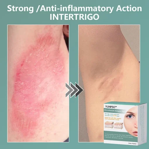 YUNPSO™ MicroNeedle Botanic Skin Tag Removal Patch - Image 4