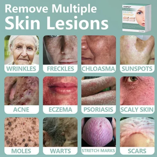 YUNPSO™ MicroNeedle Botanic Skin Tag Removal Patch - Image 2
