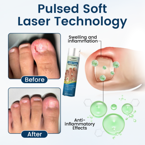 YUNPSO™ OnyxiGuard Fungal Repair Herbal Spray - Image 3
