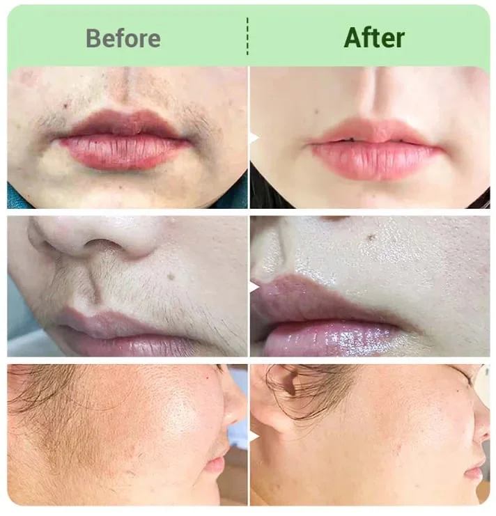 YUNPSO® Painless Hair Removal Cream for Hormonal Facial Hair - Image 2